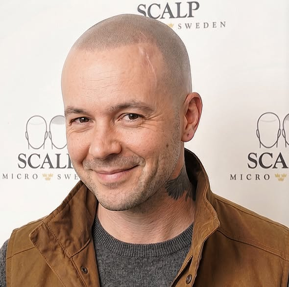 After Scalp Micropigmentation Hair Density