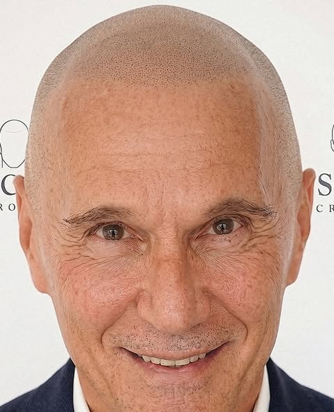 After Scalp Micropigmentation Full Head