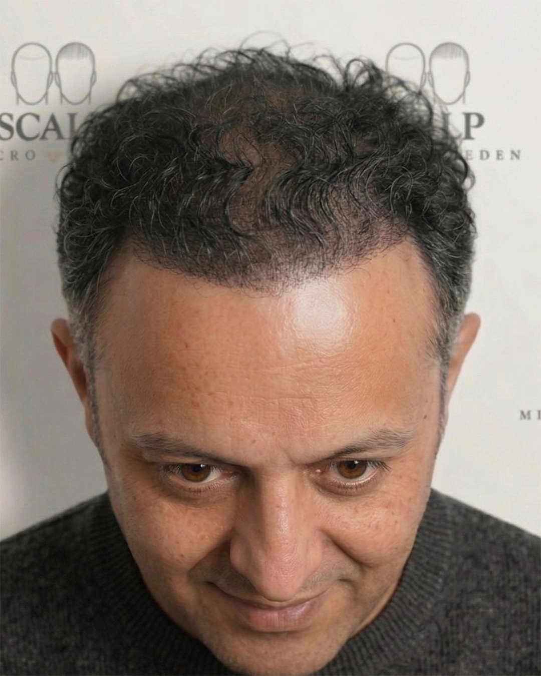 After Scalp Micropigmentation Crown Coverage