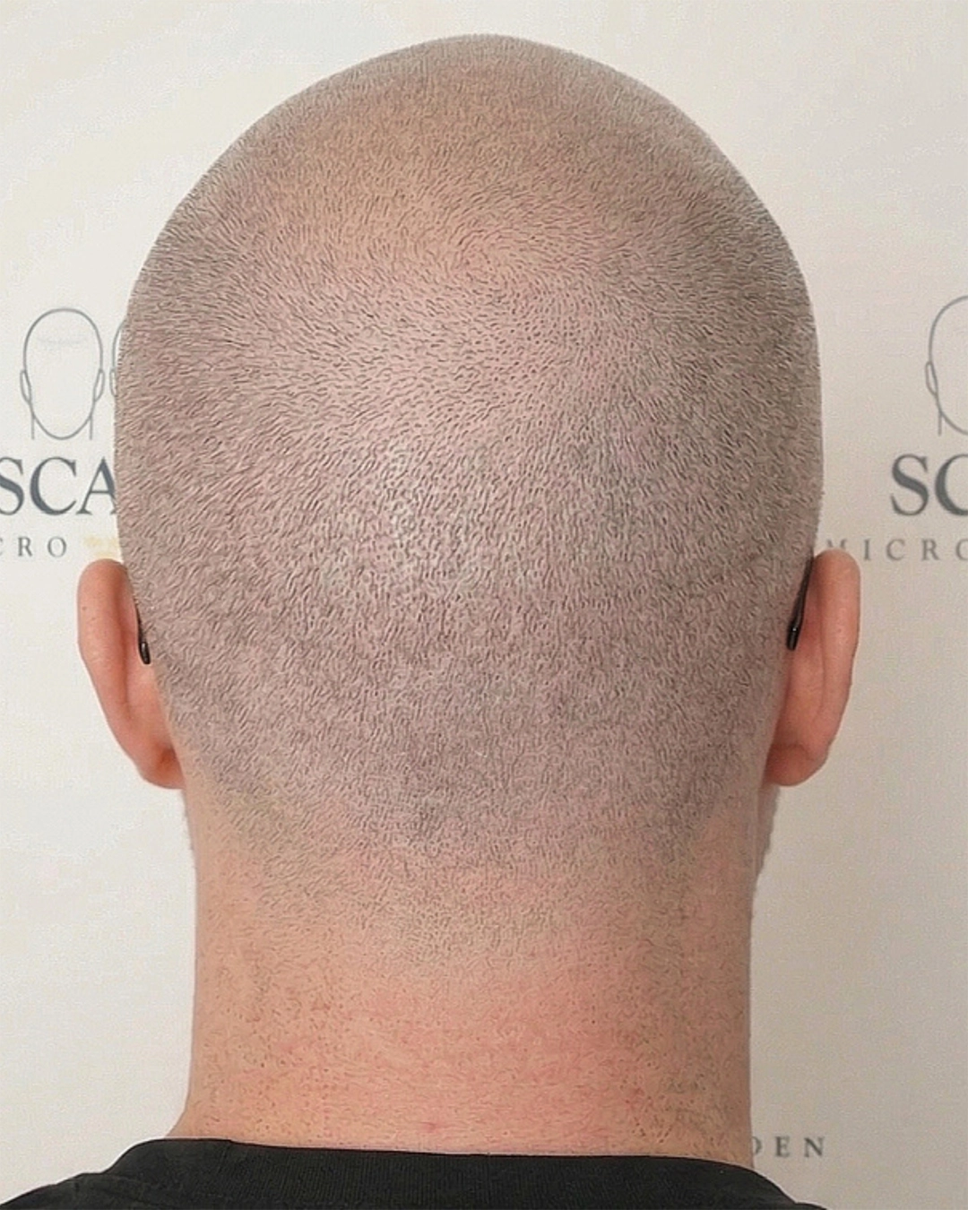 After Scalp Scar Camouflage