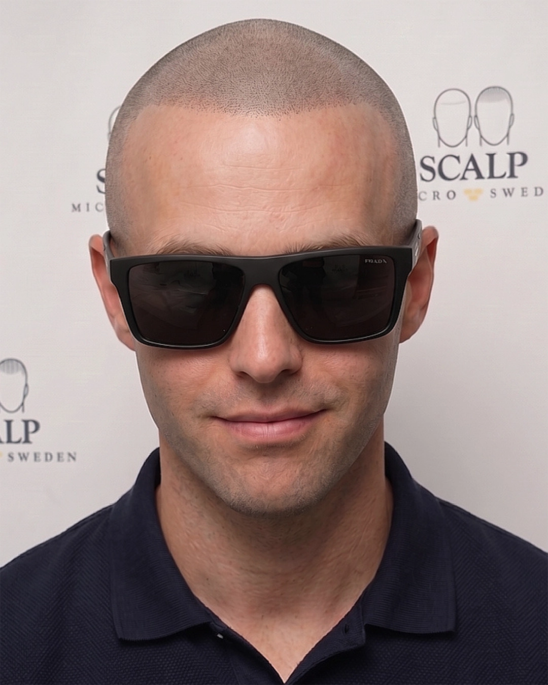 After Scalp Micropigmentation Hairline