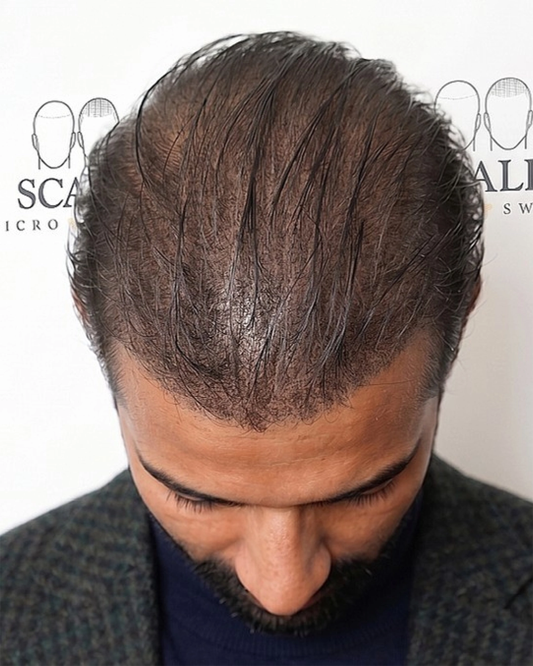 After Scalp Micropigmentation Crown