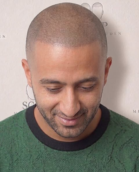 After Scalp Micropigmentation Hairline Restoration