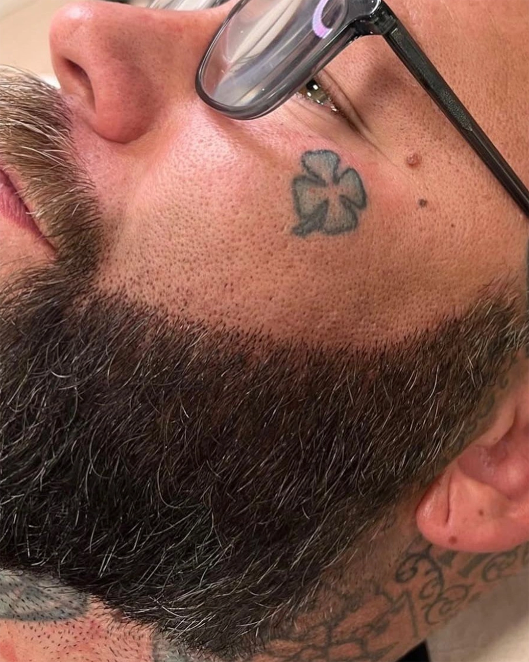 After SMP Beard Density Treatment
