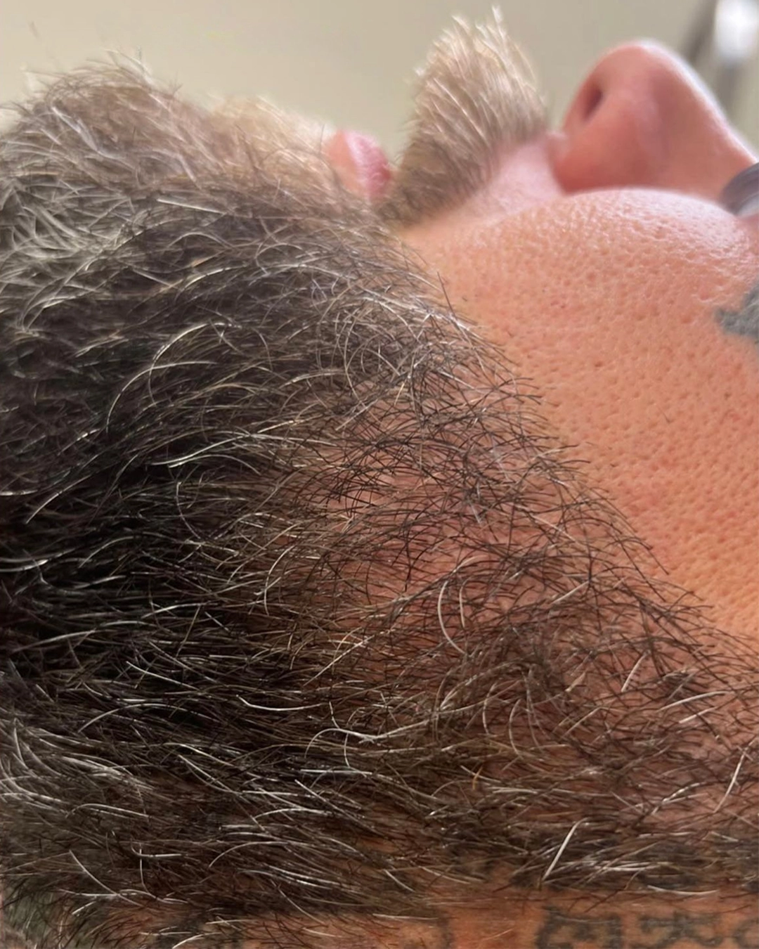 Before SMP Beard Density Treatment