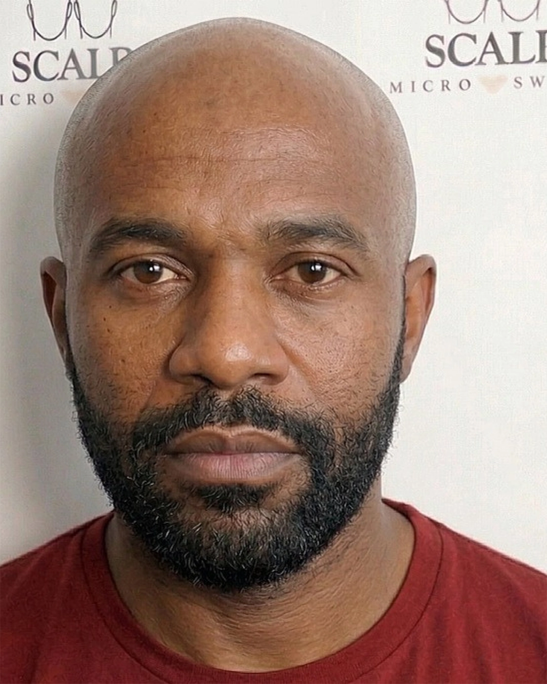 Before Scalp Micropigmentation Hairline Restoration