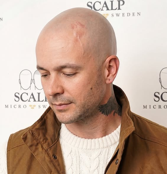 Before Scalp Micropigmentation Hair Density