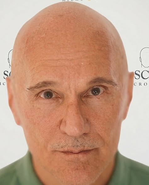 Before Scalp Micropigmentation Full Head