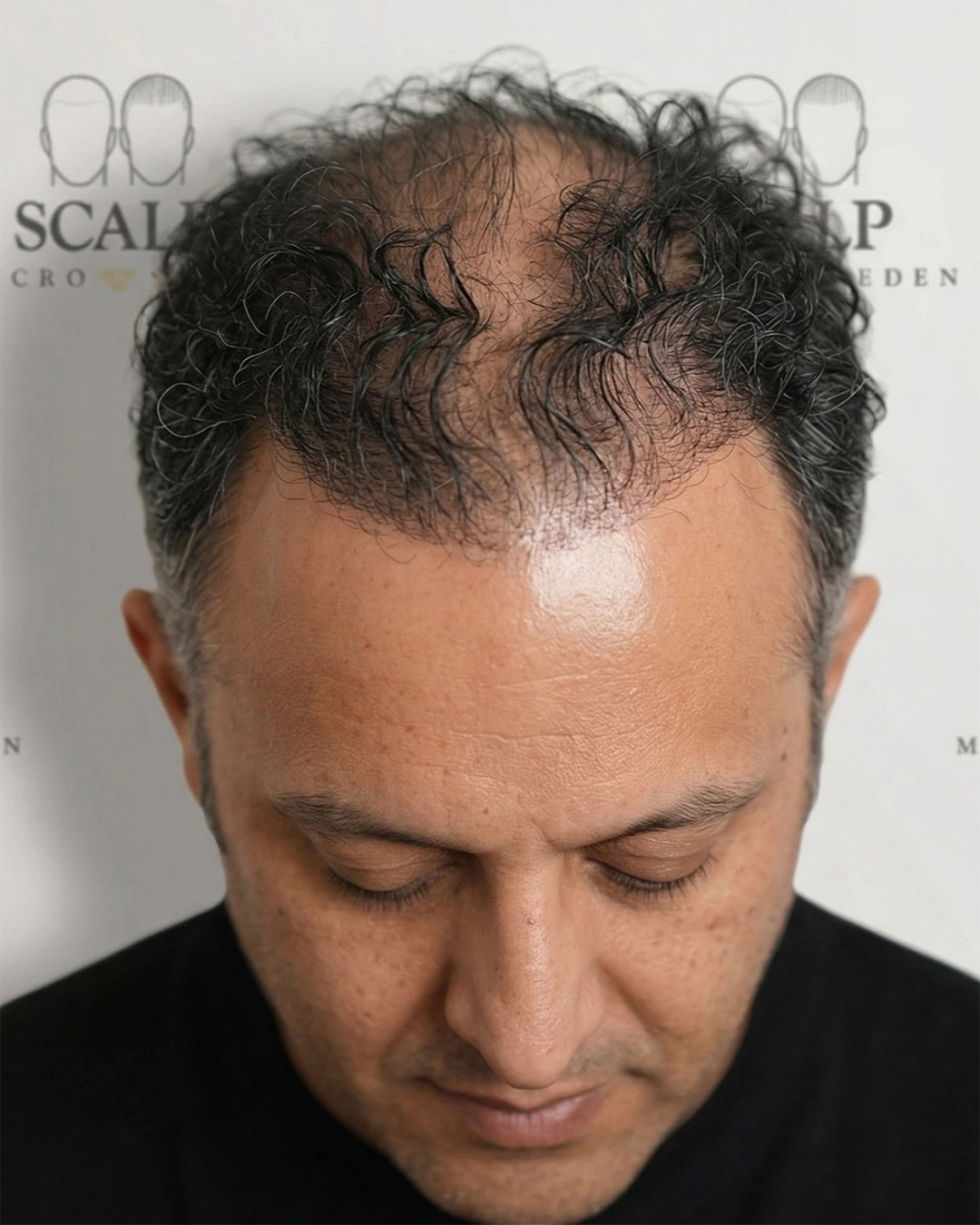 Before Scalp Micropigmentation Crown Coverage