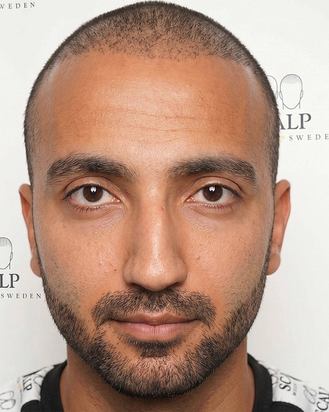 Before Scalp Micropigmentation Hair Density