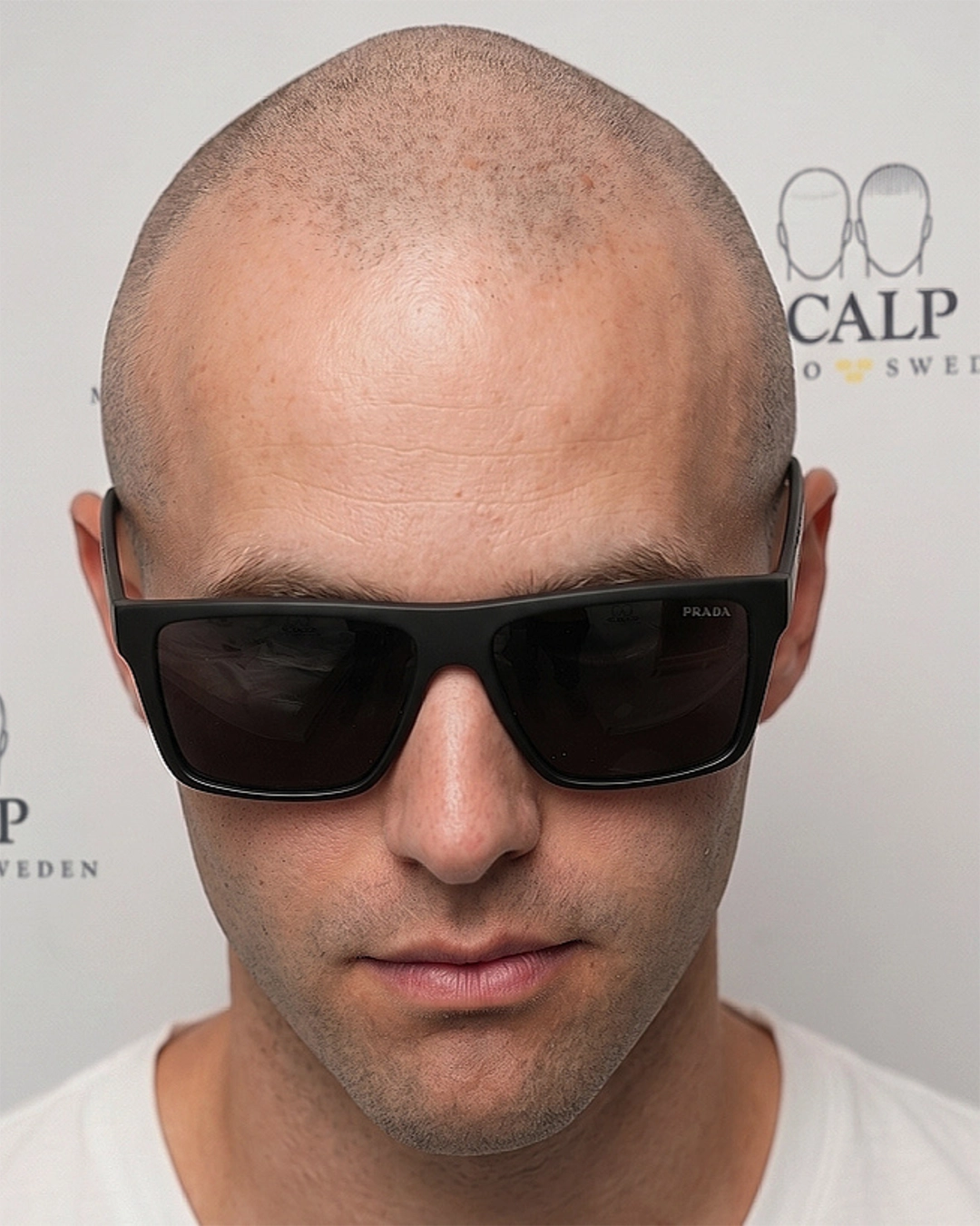 Before Scalp Micropigmentation Hairline