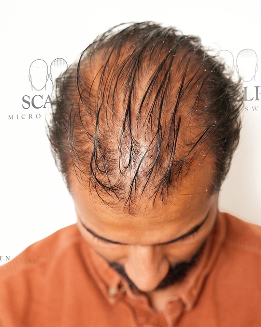 Before Scalp Micropigmentation Crown