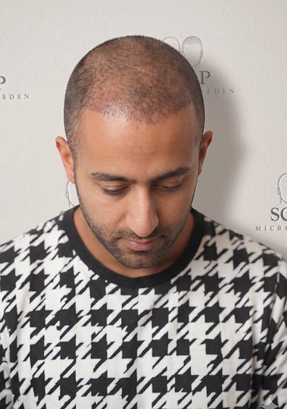Before Scalp Micropigmentation Hairline Restoration