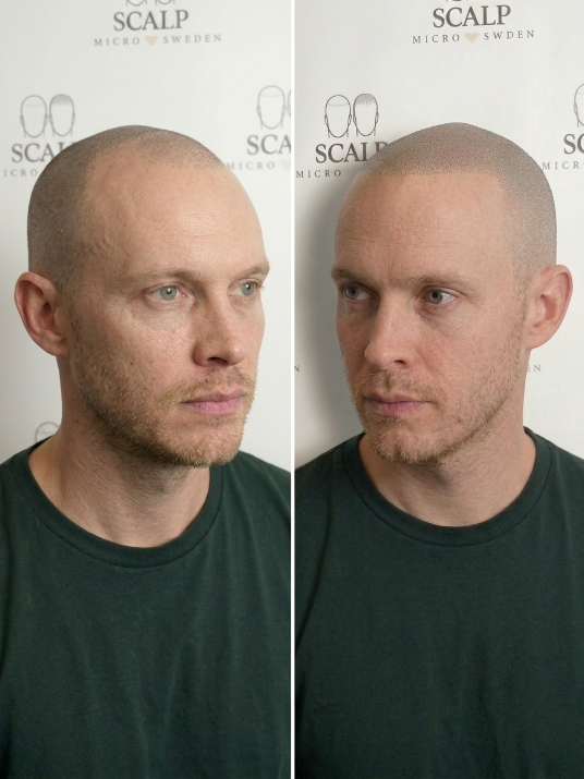 Front Hairline SMP Treatment