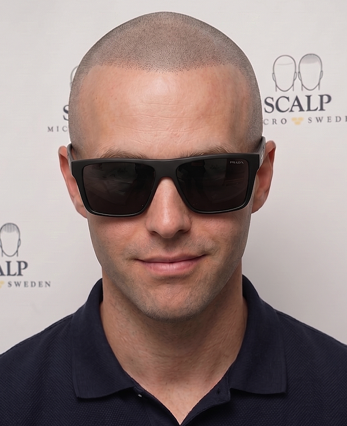 Full Head SMP Result — Natural Scalp Micropigmentation by Scalp Micro Sweden