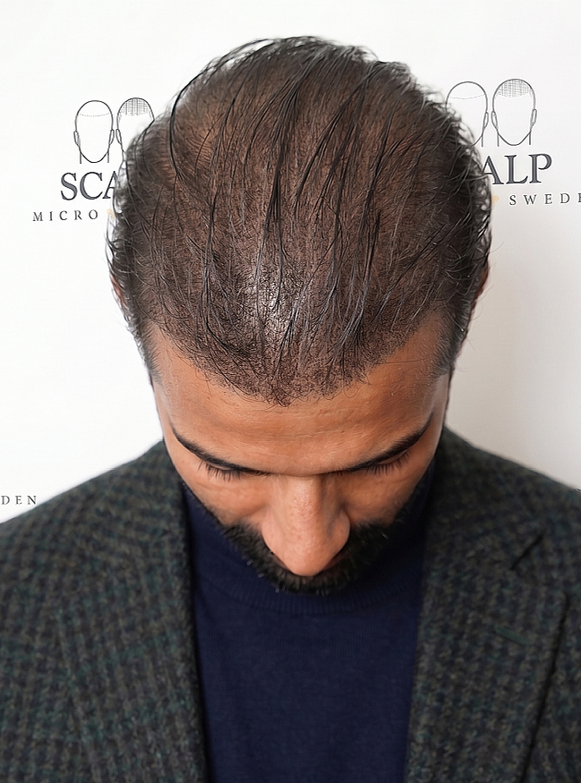 Crown & Hairline Density — Top-Down SMP Result