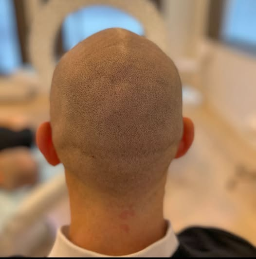 Full Head SMP Back View — Complete Hair Restoration Result